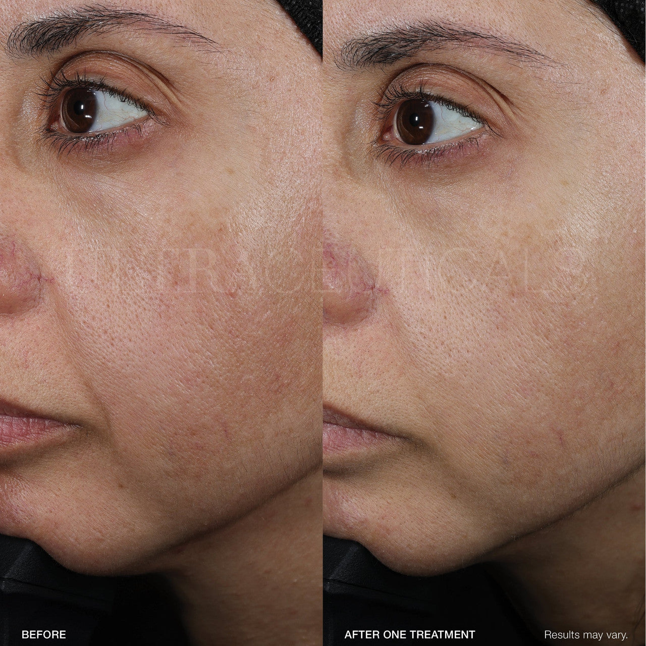 Ultra LumiBright Brightening Peel