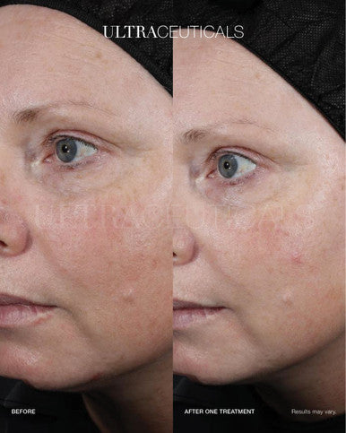 Ultra LumiBright Brightening Peel